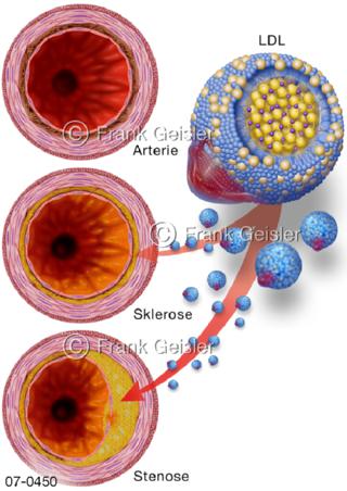 Blutgefäße, Cholesterin LDL, Sklerose und Stenose