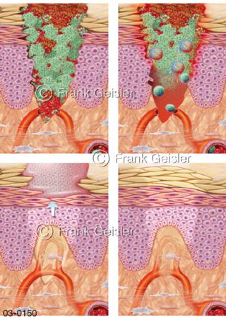 Blutgerinnung und Wundheilung, Narbenbildung der Haut