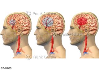 Thrombose Embolie Blutung Hirnblutung bei Schlaganfall