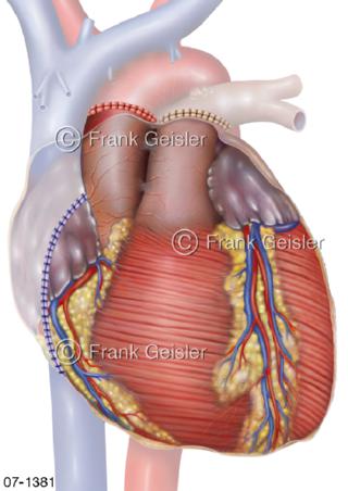 Herz Herztransplantation Standardtechnik