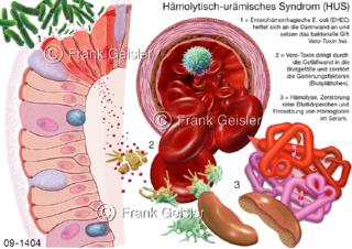 Infektion, EHEC Bakterium Verotoxin, Gift durch Escherichia coli-Bakterien im Blut