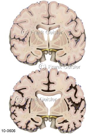 Hirnschnitte Alzheimer-Krankheit Morbus-Alzheimer Demenz