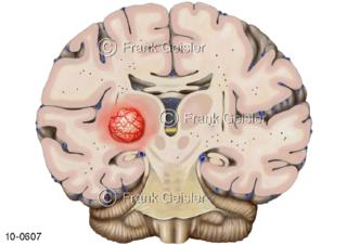 Hirnschnitt, Mittelhirn mit Hirntumor Gehirntumor Geschwulst