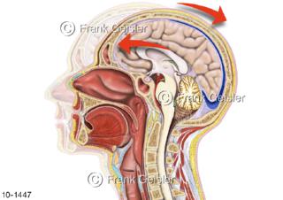Gehirnerschütterung Commotio cerebri leichtes Schädel-Hirn-Trauma