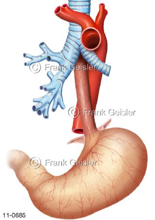 Kreuzung Luftröhre Speiseröhre Aortenenge Aortenbogen