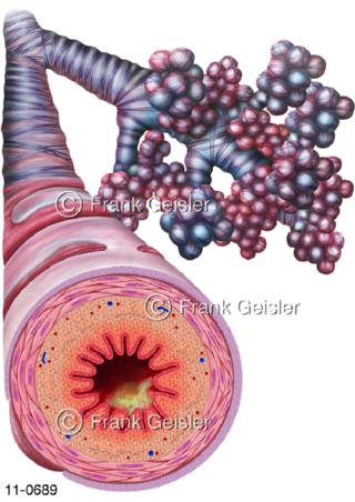  Atemwege, Bronchien mit Asthma bronchiale