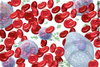 Blutzellen mit Entzündungszellen