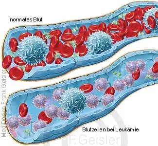 Blutgefäß mit Erythrozyten und Leukozyten, Zunahme der Leukozyten bei Blutkrebs Leukämie