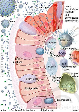 Immunreaktion der Schleimhaut, schleimhautassoziiertes lymphatisches Gewebe im Darm Immunreaktion der Schleimhaut, schleimhautassoziiertes lymphatisches Gewebe im Darm