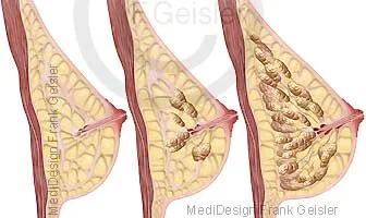 Seitenansichten weibliche Brust mit Drüsengewebe