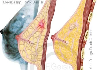 Mammakarzinom und Fibroadenom in Brust Brustdrüse